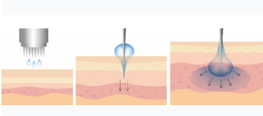 Tratamiento facial con aparatología dermapen en Centro de Belleza Dori en Motril (Granada)